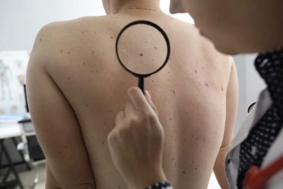 In alcuni casi, i nei sono congeniti, di origine genetica. Sebbene di solito siano innocui, alcuni di essi possono evolversi in melanoma