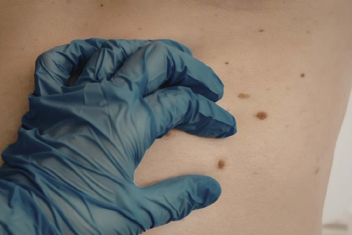 In alcuni casi, i nei sono congeniti, di origine genetica. Sebbene di solito siano innocui, alcuni di essi possono evolversi in melanoma